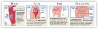 IM injections are generally safe in the arm areas and in the muscular tissue of the legs and buttocks.